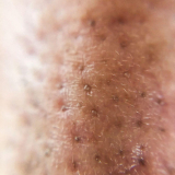 L&rsquo;observation des points noirs sur le nez au microscope